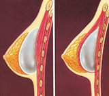 Breast Augmentation