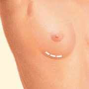 Breast Lift