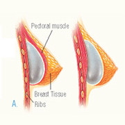 Breast Lift