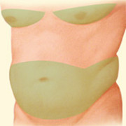 Liposuction