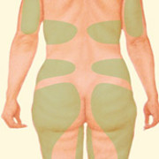 Liposuction
