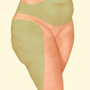 Liposuction