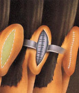 Otoplasty