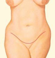 Tummy Tuck