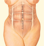 Tummy Tuck