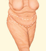 After Dramatic Weight Loss