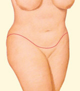 After Dramatic Weight Loss