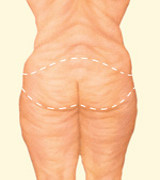 After Dramatic Weight Loss