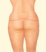 After Dramatic Weight Loss